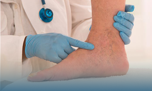 lymphedema